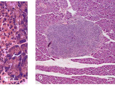 FIGURA 1: Processo de insulite  – A) Ilhota pancreática normal; B) Presença de linfócitos  T autoreativos na ilhota pancreática (Retirado de Pasquali, Giannoukakis, Trucco, 2008) 