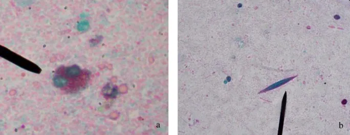 Figure  1.  a)  Eosinophil  b)  Charcot-Leyden  crystal,  both  found  in  stools  of  patients  infected  with intestinal parasites, as observed under optical microscope (1000X)
