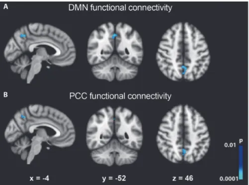 Fig 2. Changes in functional connectivity of DMN. (A) Connectivity within the PCC/Precuneus decreased after Ayahuasca ingestion
