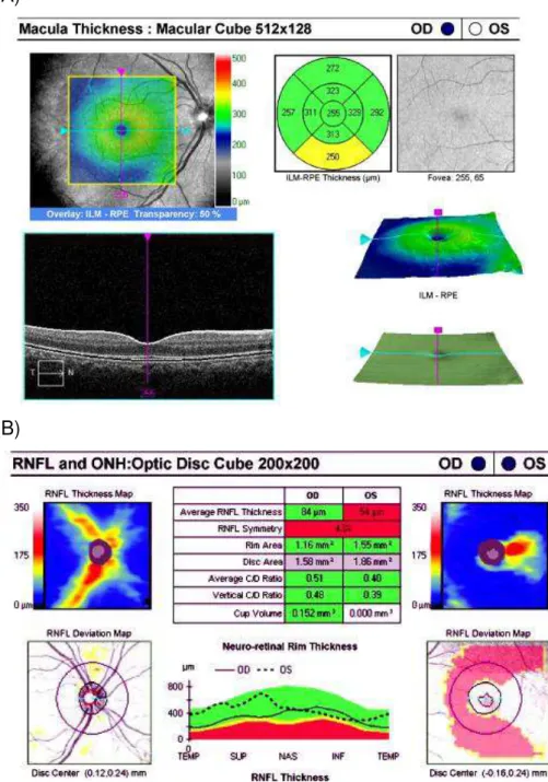 Figura  01  A)  Programa  “Macular  Cube  512x128”  que  mede  a  espessura  macular total, fornecendo um mapa com  09 sub-campos de espessuras  setoriais em três círculos concêntricos, conforme definidos pelo ETDRS