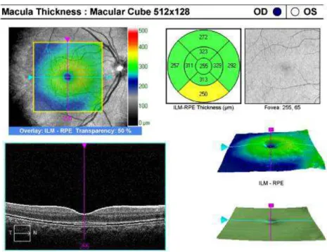 Figure 1 (A) "Macular Cube 512x128" software, measuring total macular thickness, producing a  map with 09 sub-fields of sectoral thicknesses in three concentric circles, as defined by ETDRS