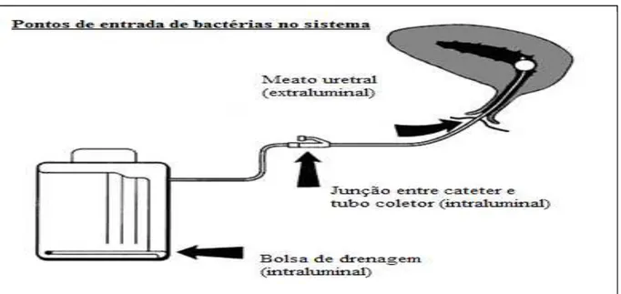 Figura 1: Pontos de entrada de bactérias causadoras de infecção do trato urinário associada ao  uso da SVD