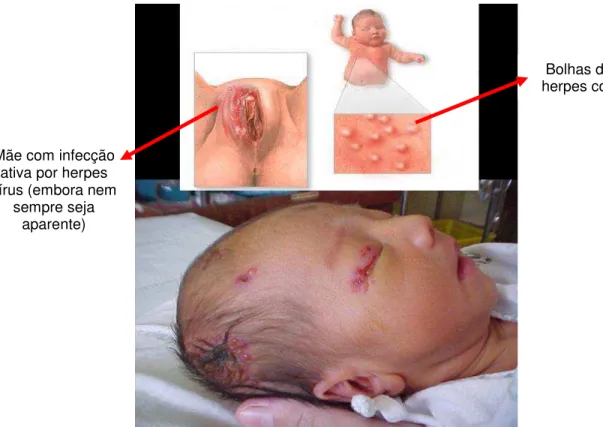 Figura  3.  Manifestação  clínica  da  infecção  por  herpes  genital  em  recém-nascido