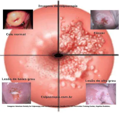 Figura  5.  Imagens  da  região  da  cérvice  uterina  através  do  exame  colposcópico  e  tipos  de  lesões  sugestivas  ao  câncer  de  colo  do  útero