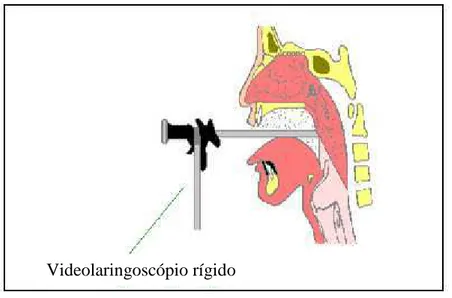 Figura 2.14 – Imagem de videolaringoscopia direta  