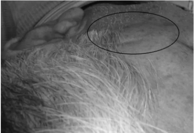 Fig. 1 Increased volume in the left temporal region on physical examination.