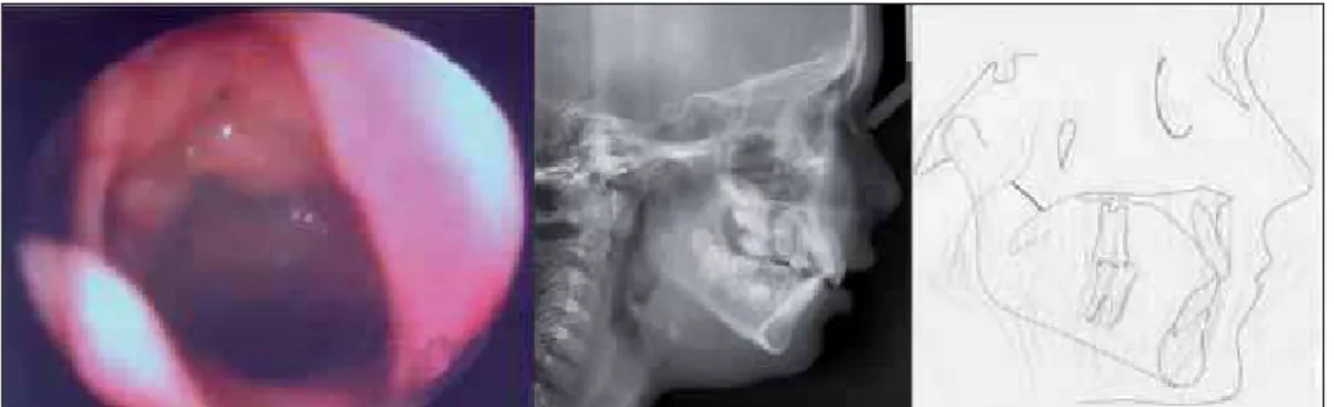 Figura 1.  Hiperplasia das tonsilas faríngeas Grau 1 na nasofibrofaringoscopia e cefalometria (telerradiografia e traçado cefalométrico)