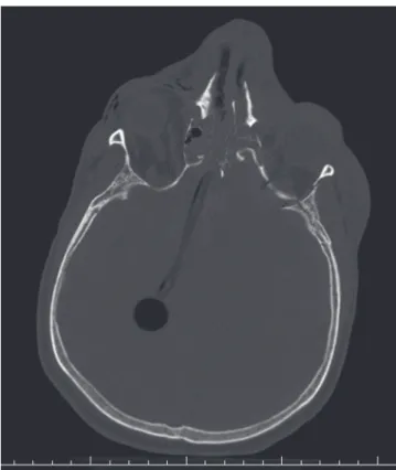 Figura 1.  Corte axial de TC de crânio evidenciando penetra-