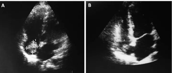 Figura 1. A. Ecodopplercardiograma transtorácico (ETT) com massa em átrio direito (AD) com dimensões de 28 x 16 mm, que poderia corresponder 