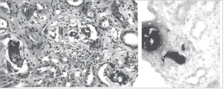 Figura 2. Aspecto da biópsia renal. A esquerda, mostra tubos com sofrimento e numerosos depósitos de material cálcico na luz; intersticio  expandido com fibrose peritubular (centro) e infiltrado celular de mononucleares; arteriolas exibem aspecto de hipert