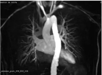 Figura 2. Angiorressonância coronal mostra arco aórtico de 