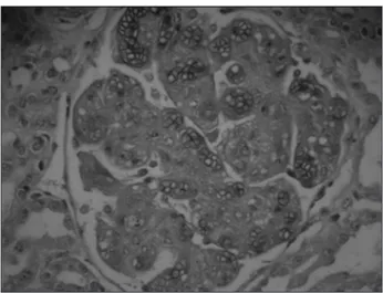 Figura 1. Histologia renal mostrando endoteliose e trombos em glomérulo 