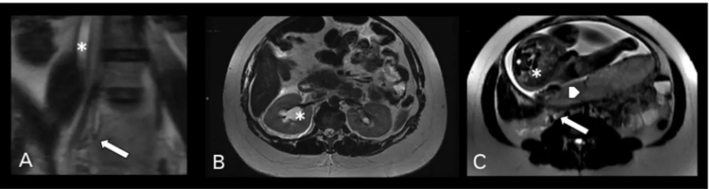 Figura 1. Ressonância nuclear magnética de gestante no 3º trimestre com ureterolitíase à direita: A: Imagem axial em T2 FSE demonstrando 