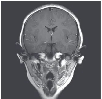 Figura 2. Ressonância magnética de crânio não revela 