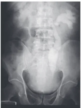 Figura  3.  Urografia  excretora  mostrando  uretero- uretero-hidronefrose à esquerda.