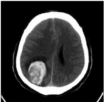 Figura 1 – Tomografia de crânio mostrando lesão intra-axial hiperdensa, bem delimi-