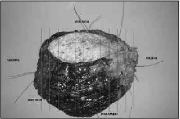 Figura 1 – Fotografia macroscópica de produto de ressecção segmentar da mama  direita