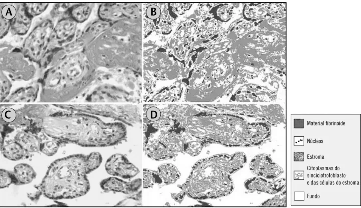 Figura 1 – (a) Imagem de placenta de gestação com pré-eclâmpsia (HE, 400 ×); (C) imagem de placenta de gestação sem pré-eclâmpsia (HE, 400 ×); (b e D) imagens segmentadas 