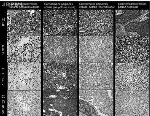 Figura  –  Painel  imuno-histoquímico  sugerido  na  diferenciação  do  carcinoma  epidermoide  variante  pequenas células com o carcinoma neuroendócrino  de  pequenas  células,  tanto  no  padrão  em  grão  de aveia quanto no intermediário (ressalta-se qu