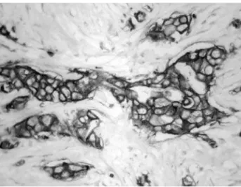 Figura 1 –  Padrão membranar da imunoexpressão da proteína cerb-2 em carcinoma  ductal infiltrante (CDI)