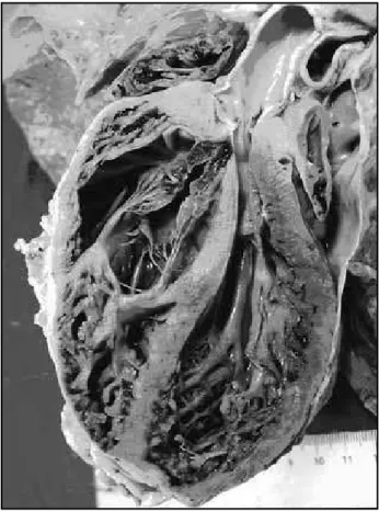 Figura 1 – Macroscopia do coração com miocárdio não compactado (esponjoso) nos  terços médio e apical do ventrículo esquerdo