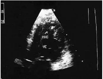 Figura  4  –  Ecocardiograma  mostrando  área  de  não  compactação  miocárdica  no  ventrículo esquerdo