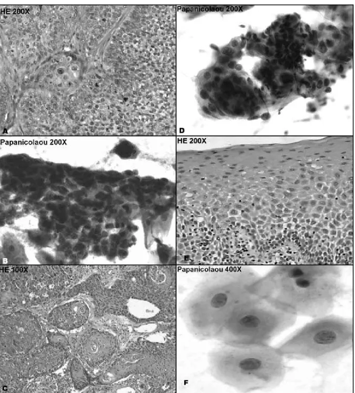 Figura 1A – Histopatologia: ninhos de células epiteliais escamosas atípicas entremeadas por conjuntivo denso, exibindo aumento da relação núcleo-citoplasma, graus variados 