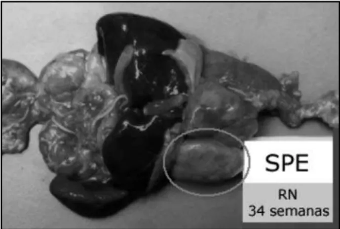 Figura 4 – Aspecto macroscópico do caso 2 Seta: seqüestro pulmonar extralobar.Figura 3 – Microscopia (HE 60x) do pedículo do seqüestro pulmonar do caso 1