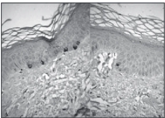 Figura  2  –    Caso  3:  imunomarcação  para  HMB-45.  Notar  a  ausência  de  células  marcadas na pele lesada (B) (400x)