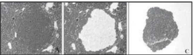 Figura 2 – Microdissecção e captura a laser de um adenocarcinoma renal de células  tubulares