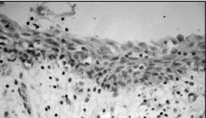 Figura 1 – Marcação difusa da MMP-1 no revestimento epitelial e focal na cápsula 
