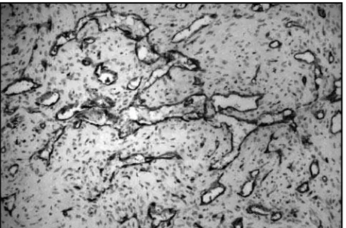 Figura 3 – Expressão da actina de músculo liso pelas células musculares neoplásicas. 