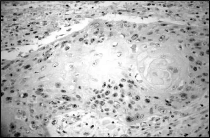 Figura 2 – Marcação imunoistoquímica pelo Ki-67 em carcinoma de células escamosas   oral HPV-negativo, evidenciando um alto índice de células em proliferação