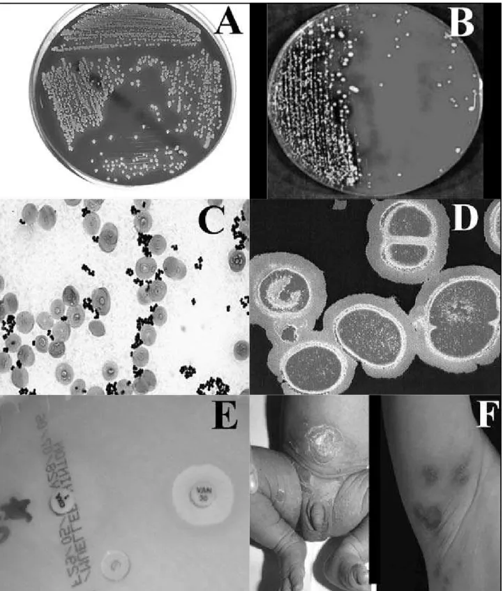 Figura 1 – Características do S. aureus. A: colônias crescidas em meio de àgar-sangue; B: visão macroscópica de colônias de VRSA; C: S