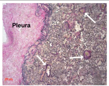 Fig. 8 - Microfotograﬁ  a do pulmão exibindo vênulas com paredes espessas,  resultado da congestão passiva crônica