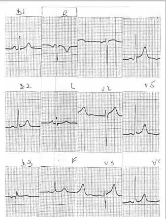Figure 1 - ECG. Signs of Probable left atrial overload.