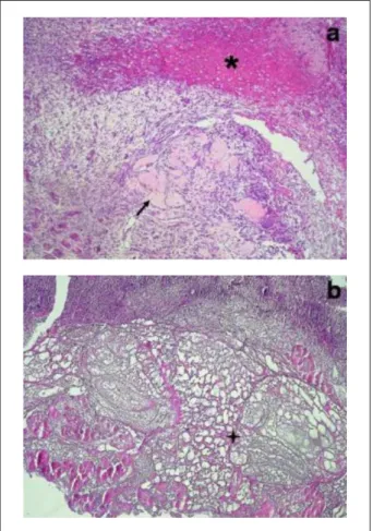 Figure 1 - Defect at 7 days: (a) Group St: hemorrhage (  ) and focuses of   osteoid matrix (  )