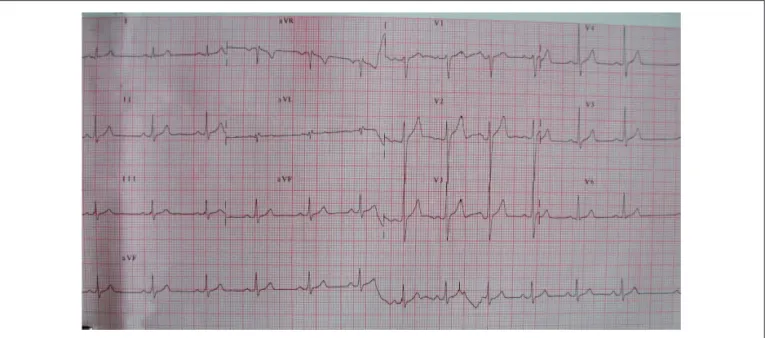 Fig. 1 - Eletrocardiograma normal.
