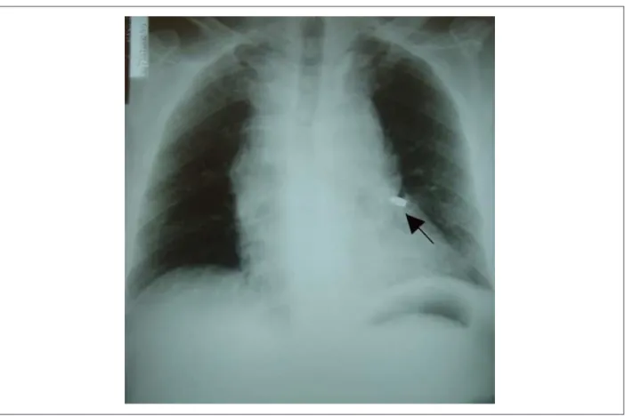 Figure 1 - Chest X-ray showing mediastinal widening and a bullet in the left hemithorax (arrow).
