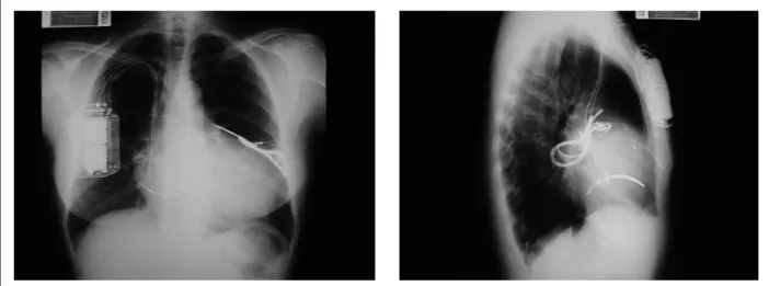 Fig. 3 - Chest x-ray in AP and side views. Patient with ICD on the right side due to previous pacemaker implant, thus maintaining the prior surgical site