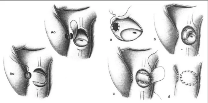 Fig. 1 - Schematic Takeuchi procedure; A - side-to-side anastomosis between the aorta and the pulmonary artery after creation of an aortopulmonary window; B - construction  of the intrapulmonary tunnel encircling the ostium of the left coronary artery; C -