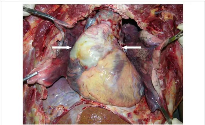 Fig. 3 - View of the corpse after removal of the rib cage and pericardium showing a markedly dilated ascending aorta (arrow).