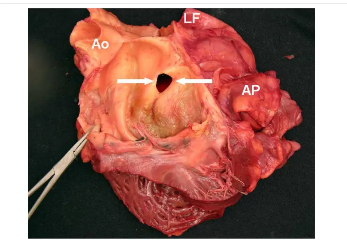 Fig. 5 -  Aorta (Ao) and left ventricle showing a bicuspid aortic valve and an oriice of 1.5 cm (arrow) communicating with the false lumen (FL).