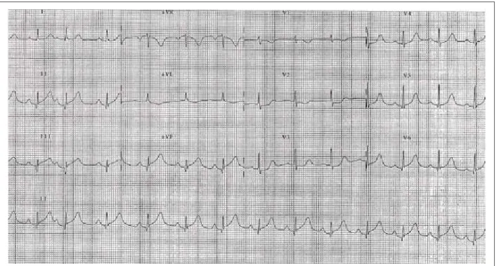 Fig. 1 - C12-lead ECG on patient admittance at the emergency room.