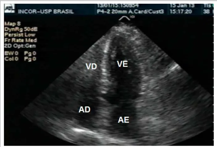 Fig. 3 - Echocardiogram performed on admission day shows left ventricle diastole and systole with apical aneurysmal dilation – typical in Takotsubo cardiomyopathy
