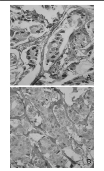 Figura 1 – Expressão imuno-histoquímica do BRCA1 em carcinomas mamários. 