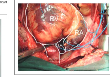 Fig. 1 - Pacebox. LA - left atrium; RA - right atrium; RV - right ventricle. 