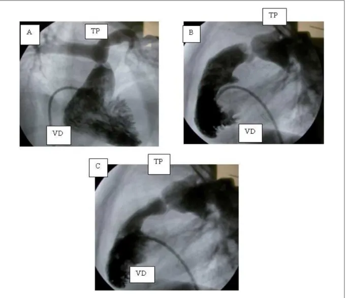 Fig. 2 -Angiogra ﬁ  a em ventrículo direito demonstrando estenose pulmonar supravalvar pulmonar em A (projeção póstero-anterior) e em B (projeção em oblíqua anterior esquerda)  com mobilidade valvar normal, além de estenose pulmonar infundibular em C (proj