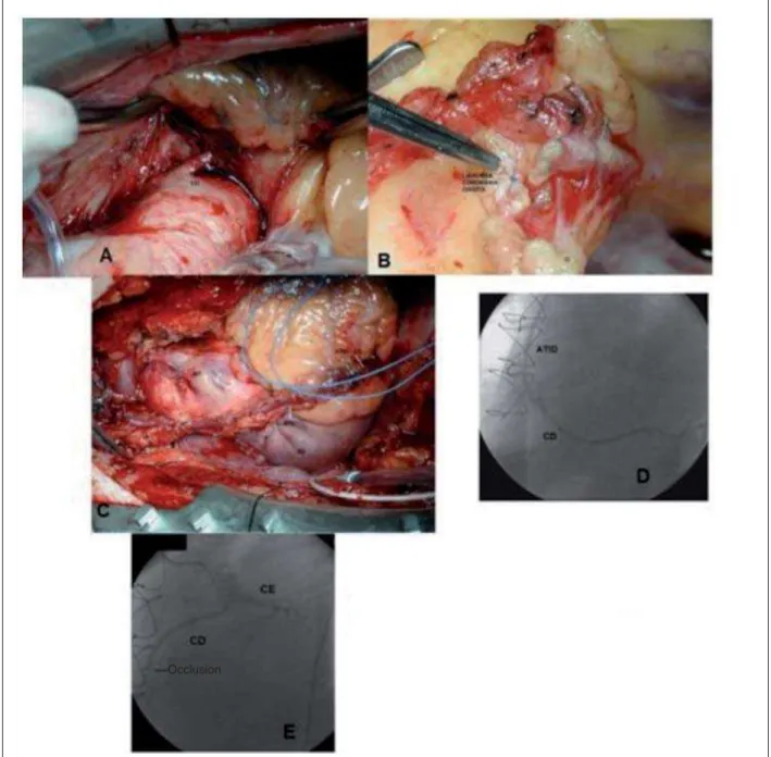 Fig. 2 - A - Intraoperative image showing the anomalous origin of the right coronary arising from a single ostium (left coronary ostium)