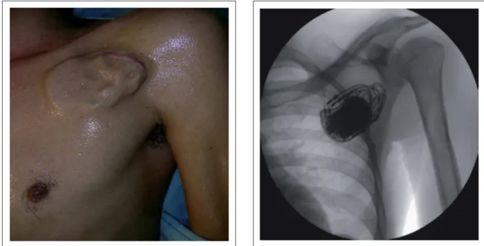 Fig. 1 - Ectoscopy of the chest showing ICD generator implanted in the  subcutaneous layer, with an irregular surface suggesting a “ball of yarn” formed  by the electrodes enveloping the pulse generator.